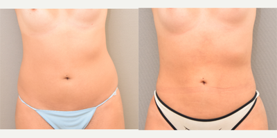 23 year old woman treated with SAFELipo - Liposuction abdomen, flanks and sacrum with fat transfer to buttocks.