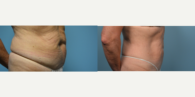 55-64 year old woman treated with Thermage FLX - Patient had Thermage FLX of the stomach to help with skin laxity..