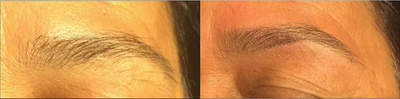 Woman treated with Eyebrow Transplant - Woman treated with Eyebrow Transplant.