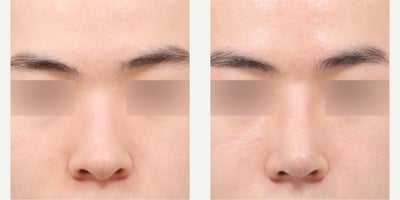 25-34 year old man treated with Asian Rhinoplasty, Rhinoplasty - He had rhinoplasty (bulbous tip correction, hump smoothing, lateral osteotomy, long nose correction, rib cartilage)