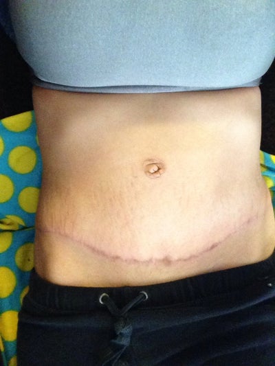Why does my belly button look weird? (photos) Doctor ...