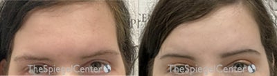 25-34 year old transgender woman treated with Forehead Reduction - Forehead contouring