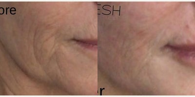 Woman treated with Skinvive by Juvederm - Woman treated with Skinvive by Juvederm