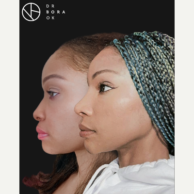 35-44 year old woman treated with Facelift - 35-44 year old woman treated with Facelift