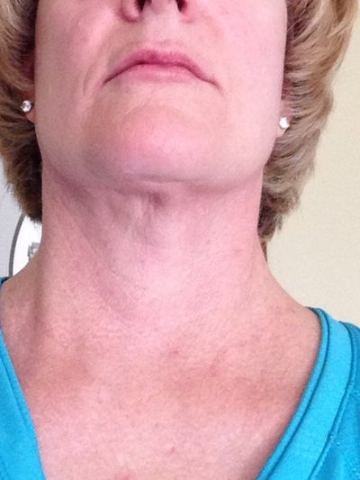 Bad Neck Liposuction/mini Facelift? (photo) Doctor Answers, Tips