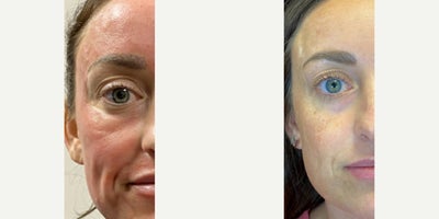 35-44 year old woman treated with Microneedling - Treated by Alyssa G