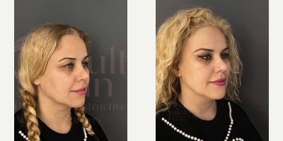 35-44 year old woman treated with Canthoplasty, Brow Lift, Eyelid Surgery - temporal lifting