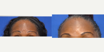 45-54 year old woman treated with Daxxify - injection area: glabella AKA frown lines, and foreheadInjected by: Scarlet PA-C