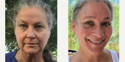 55-64 year old woman treated with MACS Facelift, AccuLift, Mini Neck Lift, Facelift, Breast Lift, Facial Fat Transfer - MACS Face Lift, Neck Lift and Breast Ptosis done by Dr. Lee Ji WonForehead Lift, Lower Blepharoplasty, Undereye Fat Repositioning done by Dr. Kim Seung Min