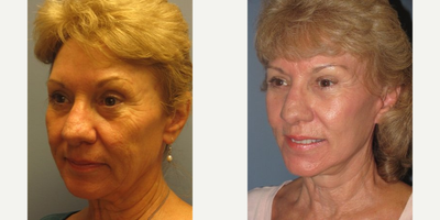 62 year old woman treated with Blue Peel - This 62-year-old woman had a Blue Peel at the same time as havingthe LiteLift lower facelift andtemple lift. Notice how the Blue Peel resultedin a beautiful, natural look. Notice in her post-op photos a now refreshed, rejuvenated and rested appearance.