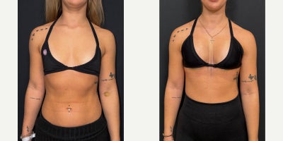 275 cc Motiva Full - dual-plane (submuscular) position - A 275 cc Motiva Full implant placed in a dual-plane (submuscular) position.