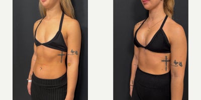 275 cc Motiva Full - dual-plane (submuscular) position - A 275 cc Motiva Full implant placed in a dual-plane (submuscular) position.