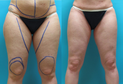 35-44 year old woman treated with Body-Jet - Female patient underwent liposuction to treat inner thighs, flanks and abdominal area.