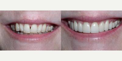 10 porcelain veneers - Patient was never happy with her teeth. We were able to give her the smile she wanted with 10 porcelain veneers.