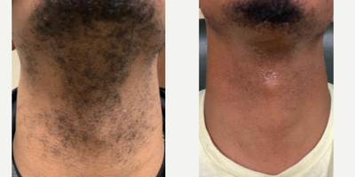 35-44 year old man treated with Laser Hair Removal - Before and after 6 laser hair removal treatments