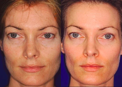 Active/Deep FX Laser - 	Uses Active/Deep FX laser treatments to resurface and rejuvenate the patient's facial appearance.