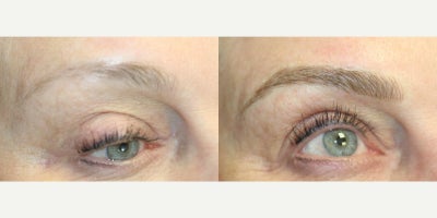 65-74 year old woman treated with Microblading, Permanent Makeup - Microblading is a precision-based form of cosmetic tattooing designed to enhance and restore natural brow shape. Each treatment is performed by Ruth Swissa, CMM, a leading expert in medical micropigmentation.Using a sterile, single-use microblade, ultra-fine pigment is deposited into the superficial dermis to create realistic, hair-like strokes that blend seamlessly with existing brow hair. Each procedure includes a detailed facial analysis and custom brow mapping to ensure symmetry, balance, and a tailored result.Ideal for patients with thinning brows, asymmetry, or hair loss, microblading delivers soft, natural-looking enhancement with results that continue to refine as the pigment settles. *A follow-up session is recommended to perfect the final outcome.