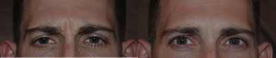 30 Year Old Male Treated For Glabellar Lines  - Botulinum toxin was used conservatively to treat glabellar (11) lines in this young male.  Not the improvement in active wrinkles without a change in expression or masculinity.