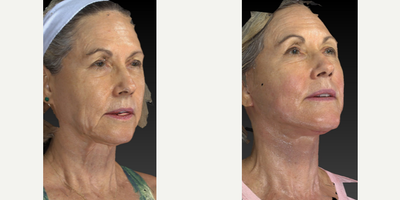 65-74 year old woman treated with Neck Lift - This very pretty woman was concerned about her jowl area and the excess skin under her neck. We did a lower face and neck lift with platysmaplasty.  Looking good!