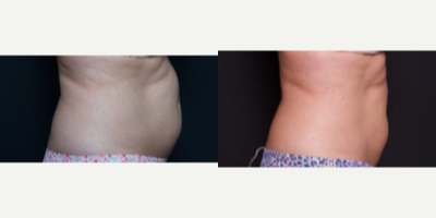 45-54 year old woman treated with SculpSure - 35-44 year old woman receives a total of 2 SculpSure treatments to abdomen and 1 treatment to love handles, performed at 12 week intervals.