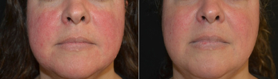 Middle Aged Female Treated for Facial Redness (Rosacea) - Redness of the face can be improved dramatically with lasers such as the pulsed dye laser and the Excel V (KTP) laser.&nbsp;