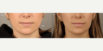 Non-Surgical Jaw Reduction (Botox for TMJ/Masseters) - 33-year-old female with a history of discomfort related to grinding and clenching teeth at night, and slight lower facial fullness.  She is shown six weeks after Botox treatment to the masseter muscles, which served to relieve her symptoms and reduce some squareness of her jaw. She also received lip augmentation with filler at the same time.