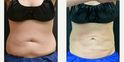 45-54 year old woman treated with Morpheus8 - 46 yo female 1 year s/p Bodytite Abdomen with Liposuction and Morpheus 8 treatment.