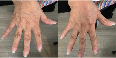 Woman treated with Renuva - Woman treated with Renuva
