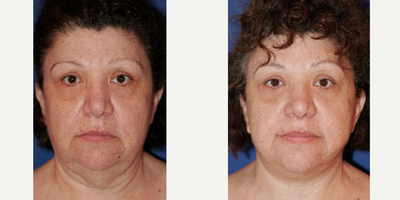 55-64 year old woman treated with Neck Lift - 60 year old female who had Neck Lift with Neck Liposuction