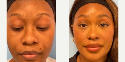 25-34 year old woman treated with African American Rhinoplasty - 32 year old female underwent Alarplasty/Tipplasty surgery under local anesthesia.