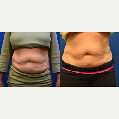 55-64 year old woman treated with Evolve - This patient treated with evolve trim at tite for a total of 6 treatments. This is a great way to break down fat without surgery.