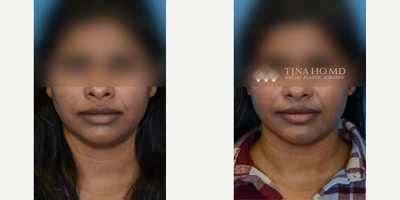 25-34 year old woman treated with Lip Reduction - 32 year-old female with concerns of large, protruding lower lip who underwent lower lip reduction surgery for facial balancing