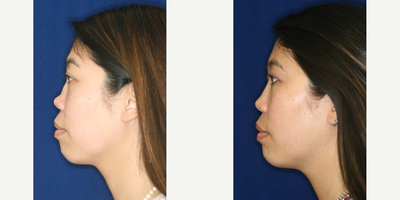 Permanent Non-surgical Rhinoplasty - Restoration to pre-injury appearance after accident leading to collapse of the bridge.