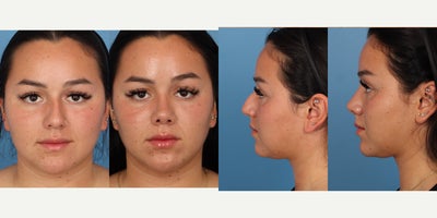 18-24 year old woman treated with Rhinoplasty - Rhinoplasty with Dr. Chasan