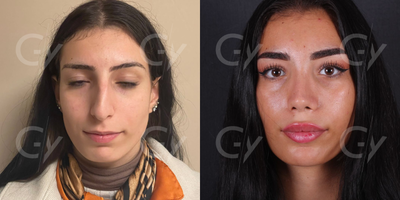 25-34 year old woman treated with Rhinoplasty - Rhinoplasty by M.D. Gray Yeiladal