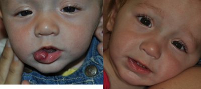 hemangioma - patient with lower lip hemangiona , excised surgically