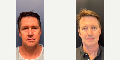 Man treated with Neck Lift - Man treated with Deep Plane Facelift, Deep Plane Neck Lift, Facial Fat Transfer, Eyelid Surgery through upper blepharoplasty and lower blepharoplasty, and subtle Brow Lift.