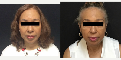 65-74 year old woman treated with Nutrafol - This patient is thrilled by the regrowth of hair after 4 months use of Nutrafol Balance. It may be difficult to see in this view, but all the gray hairs of the temples and frontal hairline are new, and are quite dense in the temples which previously were completely bald. The balding patch on top of her head has filled in as well.