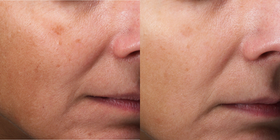 35-44 year old woman treated with PicoSure - 35-44 year old woman treated with PicoSure