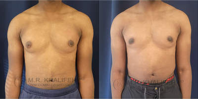 Man treated with Gynecomastia Surgery - Man treated with Gynecomastia Surgery