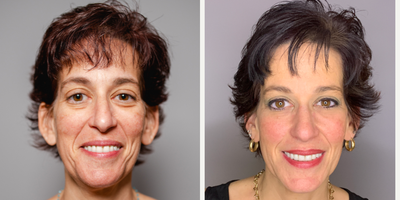 45-54 year old woman treated with Nonsurgical Facelift - Fat transfer to face with laser and RF treatments