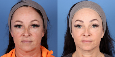 53 year old woman treated with Halo Laser, Laser Resurfacing, Laser Peel - Contour TRL laser used (by Sciton) for full face resurfacing and treatment of smoker's lines