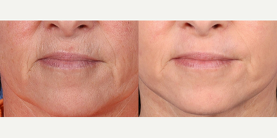 53 year old woman treated with Halo Laser, Laser Resurfacing, Laser Peel - Contour TRL laser used (by Sciton) for full face resurfacing and treatment of smoker's lines