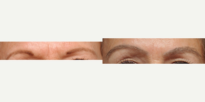 56 year old woman treated with FUT Eyebrow Transplant - FUT eyebrow transplant