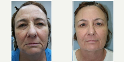 57 year old woman treated with InMode Fractora to the face and neck - Two high energy InMode Fractora treatments to the face and neck. The first was to the lower face and neck only; the second was to the full face.