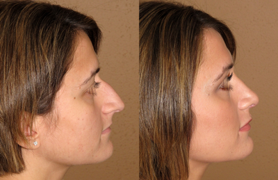 Rhinoplasty/nose job - 
	Rhinoplasty/nose job
