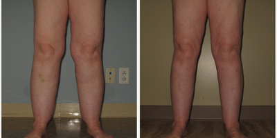 45-54 year old woman with Lipedema treated with Liposuction - Lipedema patient with Liposuction to her calves. 2 months post-op.