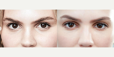 Woman treated with Dermal Fillers, RHA Redensity - RHA Redensity FillerAlthough injecting filler under the eyes can be difficult, Redensity makes it easy! With RHA Redensity filler, I can achieve a perfect finish for dynamic infraorbital wrinkles giving you that refreshed and younger look youve always wanted!
