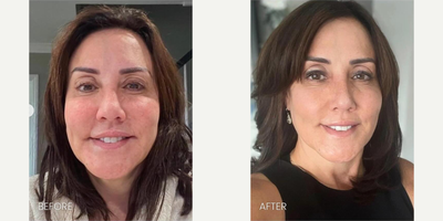 Woman treated with Microneedling RF - This patient felt overfilled, and as an injector herself, she knew that this wasnt her natural look nor the results that she wanted to achieve. Secret Pro Radiofrequency Microneedling helps to tighten the skin envelope, stimulates collagen production, and ultimately improves the overall skin quality!