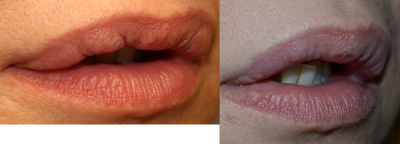 Lip Repair - Before and after lip repair.